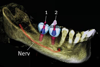 Planung eines Zahnimplantats mithilfe des DVT-Geräts
