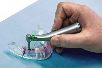 Anatomisch korrekt ausgerichtete Bohrung bei Zahnimplantaten