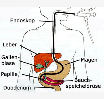 Schematische Darstellung der ERCP