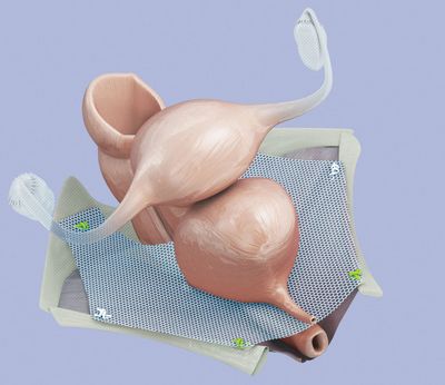 Chirurgische Netze tragen zur Stabilisierung des Beckenbodens bei. Sie stützen die Organe (wie hier im Bild die Harnblase) und verhindern deren erneutes Absinken (Quelle: www.ami.at)