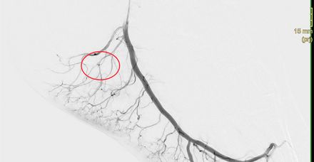 Röntgenbild nach dem Eingriff (Embolisation): Die Durchblutung ist deutlich reduziert – die Grundlage für das Abklingen der Entzündung Röntgenbild nach dem Eingriff (Embolisation): Die Durchblutung ist deutlich reduziert – die Grundlage für das Abklingen der Entzündung