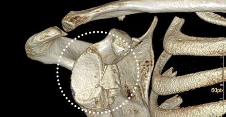 Aufnahme nach der OP: Die Gelenkfläche wurde durch ein Stück Beckenknochen vergrößert Aufnahme nach der OP: Die Gelenkfläche wurde durch ein Stück Beckenknochen vergrößert