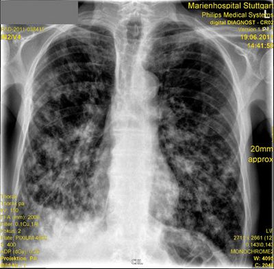 Röntgenaufnahme bei Granulomatose mit Lungenbefall