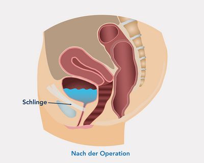 Schematische Darstellung der Belastungsinkontinzenz nach der Operation, bei der ein TVT-Band unter die Harnröhre gelegt wurde (Quelle: www.ami.at)