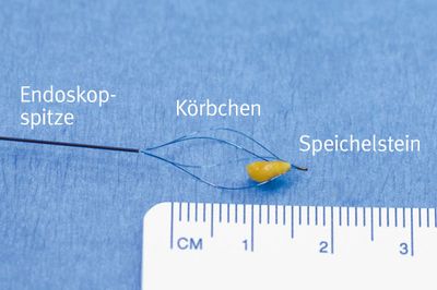 Endoskopische Speichelsteinentfernung mittels Körbchen