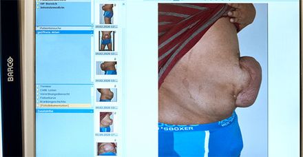 Der Bauch von Hakiim Ahmed. Nach der früheren Operation einer Schussverletzungen platzte er auf. Der Darm drückte sich durch die Bauchwand nach außen