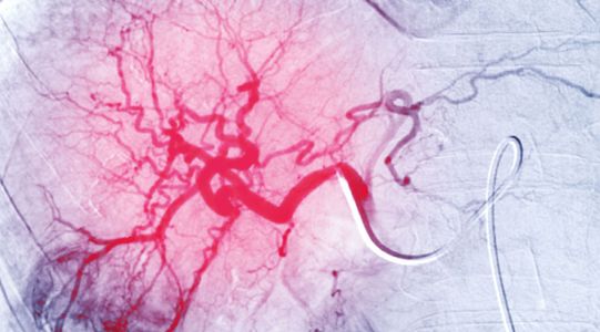 Wenn der Katheter das Skalpell ersetzt: Gef&auml;&szlig;erkrankungen werden minimalinvasiv und pr&auml;zise behandelt (Bild: shutterstock.com/Radiological imaging)