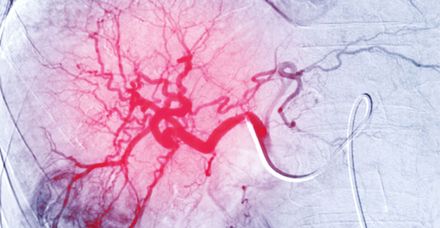 Wenn der Katheter das Skalpell ersetzt: Gefäßerkrankungen werden minimalinvasiv und präzise behandelt (Bild: shutterstock.com/Radiological imaging) Wenn der Katheter das Skalpell ersetzt: Gefäßerkrankungen werden minimalinvasiv und präzise behandelt (Bild: shutterstock.com/Radiological imaging)