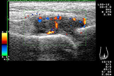 Dopplersonografische Aufnahme einer Arthritis am Zehengrundgelenk