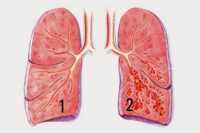 Chronisch-obstruktive Lungenerkrankung (COPD) mit Emphysem