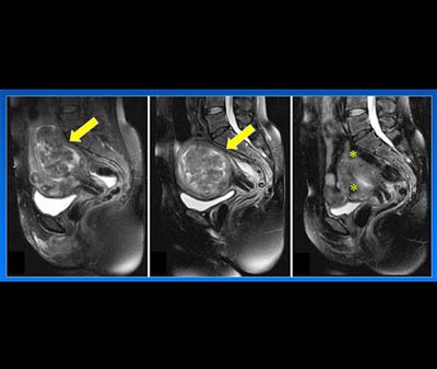 Myome der Gebärmutter im CT