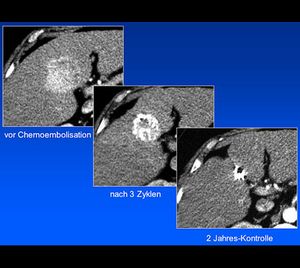 Patient mit primärem Leberzelltumor (hepatozelluläres Karzinom) im CT