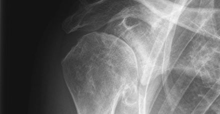 Die Röntgenaufnahme zeigt die bereits fortgeschrittene Arthrose im Schultergelenk