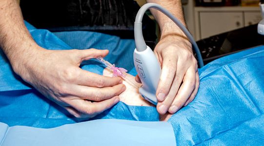 Minimalinvasiv und pr&auml;zise: &Uuml;ber einen feinen Katheter werden gezielt krankhaft ver&auml;nderte Gef&auml;&szlig;e  im Bereich der entz&uuml;ndeten Plantarfaszie verschlossen