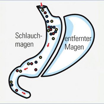 Schematische Darstellung eines Schlauchmagens