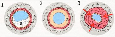 Einengung der Bronchien bei Asthma bronchiale