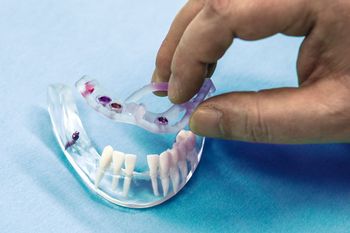 Überstülpen der Bohrschablone für Zahnimplantate