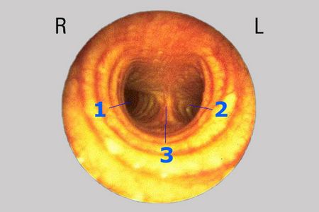 Blick mit einem Bronchoskop in die Luftröhre (Trachea)