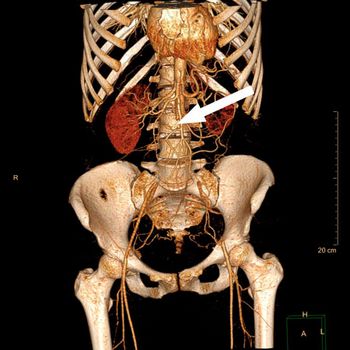 3 D-Rekonstruktion eines Patienten mit akutem Verschluss der Bauchschlagader