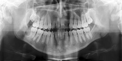 Fehlgestellte Zähne im Röntgenbild