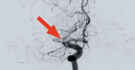 Verschluss der mittleren Hirnarterie rechts (angiografische Aufnahme)