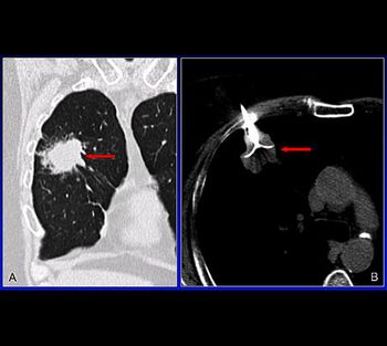 Inoperabler Tumor in der rechten Lunge (CT-Aufnahme)