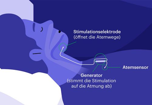 Funktionsprinzip eines Zungenschrittmachers (grafische Darstellung; Bild: Inspire)