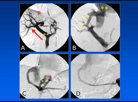 TIPS-Anlage (angiografische Aufnahmen)