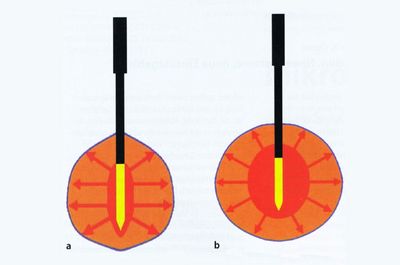 Schematische Darstellung der Mikrowellenablation (a: vor Ablation; b: nach Ablation) Schematische Darstellung der Mikrowellenablation (a: vor Ablation; b: nach Ablation)