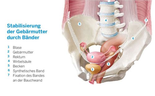 Durch eine Senkungsoperation lassen sich die betroffenen Organe (hier die Gebärmutter) mithilfe von Bändern oder Netzen wieder anheben und stützen (Bild: KSW Kantonspital Winterthur)