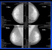 Digitale Vollfeldmammografie (Normalbefund)