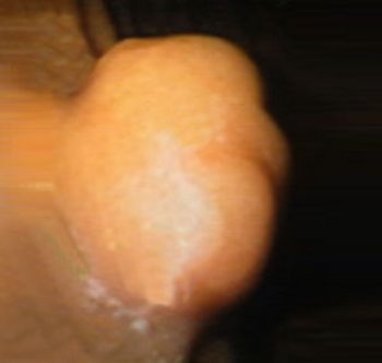 Endoskopische Aufnahme eines Magenpolypen