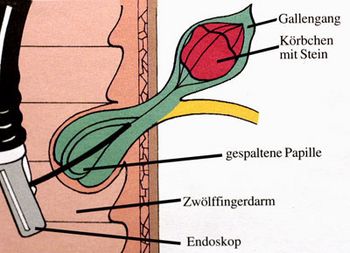 Gallensteinentfernung mittels ERCP (schematisch) Gallensteinentfernung mittels ERCP (schematisch)