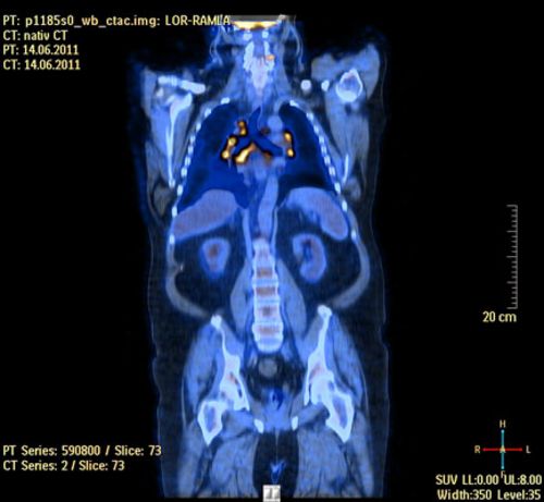 PET-CT-Aufnahme bei Sarkoidose