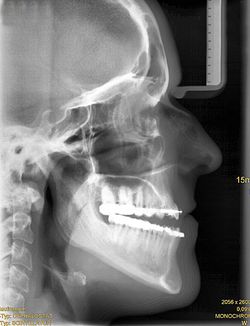 Röntgenbild des Gesichtsschädels einer Patientin mit Kieferfehlstellung