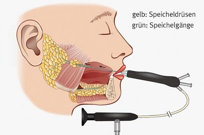 Speichelsteinentfernung mittels Endoskop