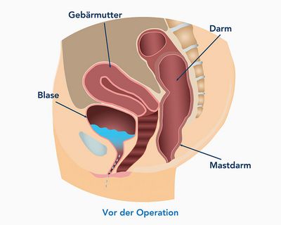 Schematische Darstellung der Belastungsinkontinenz vor der Operation (Quelle: www.ami.at)