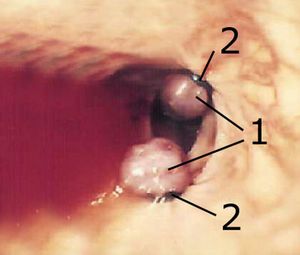 Endoskopische Aufnahme einer Krampfader in der Speiseröhre (Ösophagusvarize)