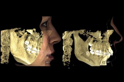 ProFace-Technik: Anfertigen fotografischer röntgenfreier Scans in 3D