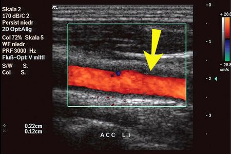 Farbduplexsonografische Aufnahme einer entzündlichen Arterienerkrankung (Riesenzellarteriitis) im Längsschnitt