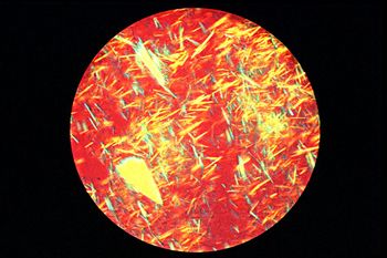 Mikroskopische Aufnahme von Harnsäurekristallen