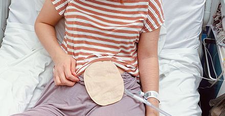 Patientin mit ihrem Stoma kurz nach der Operation