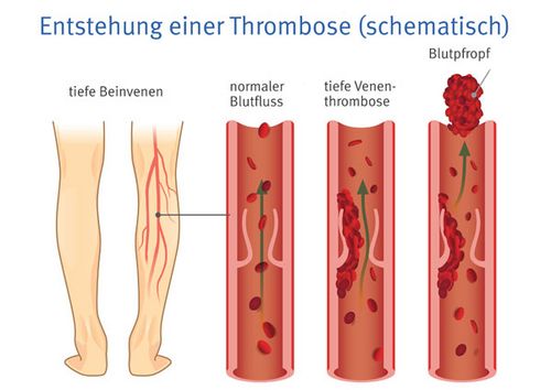 Wenn das Blut zu langsam fließt oder sich staut, können Blutgerinnsel entstehen