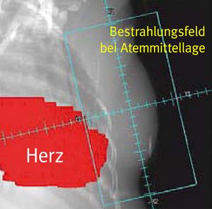 Brustkrebs: Bestrahlungsfeld ist abhängig von der Atmung