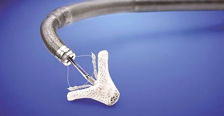 MitraClip&reg;: Dieser wird &uuml;ber einen Katheter in die linke Herzh&auml;lfte eingef&uuml;hrt und an die undichte Stelle der Mitralklappe platziert 