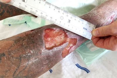 Nicht heilende Wunde am Unterschenkel („Ulcus cruris“)