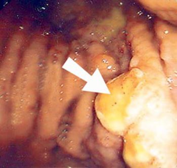 Endoskopische Aufnahme eines Magenkarzinoms