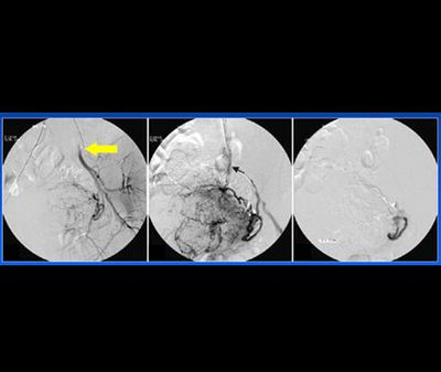 Interventioneller Verschluss der linken Gebärmutterschlagader (angiografische Aufnahmen)