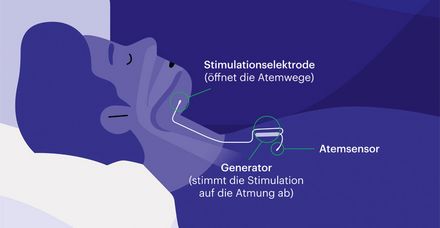 Funktion des Zungenschrittmachers: Der Atemsensor gibt über eine Stimulationselektrode milde Impulse an den Zungennerv weiter (Bild: Inspire)