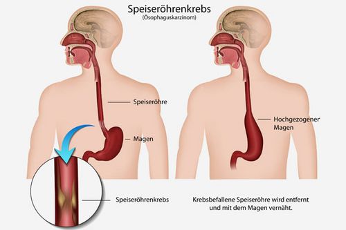 Schematische Darstellung des operativen Verfahrens bei Speiseröhrenkrebs